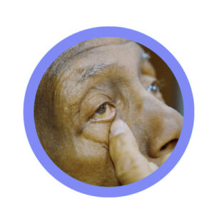 patient pulling down lid, getting ready to take eye drop medicine