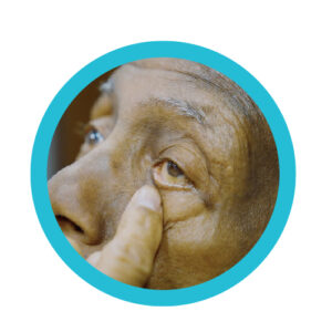 patient pulling his lower eyelid down with his finger, preparing to put eye drop medicine in his eye